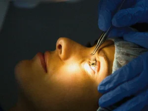 Photo of Lasik Eye Surgery